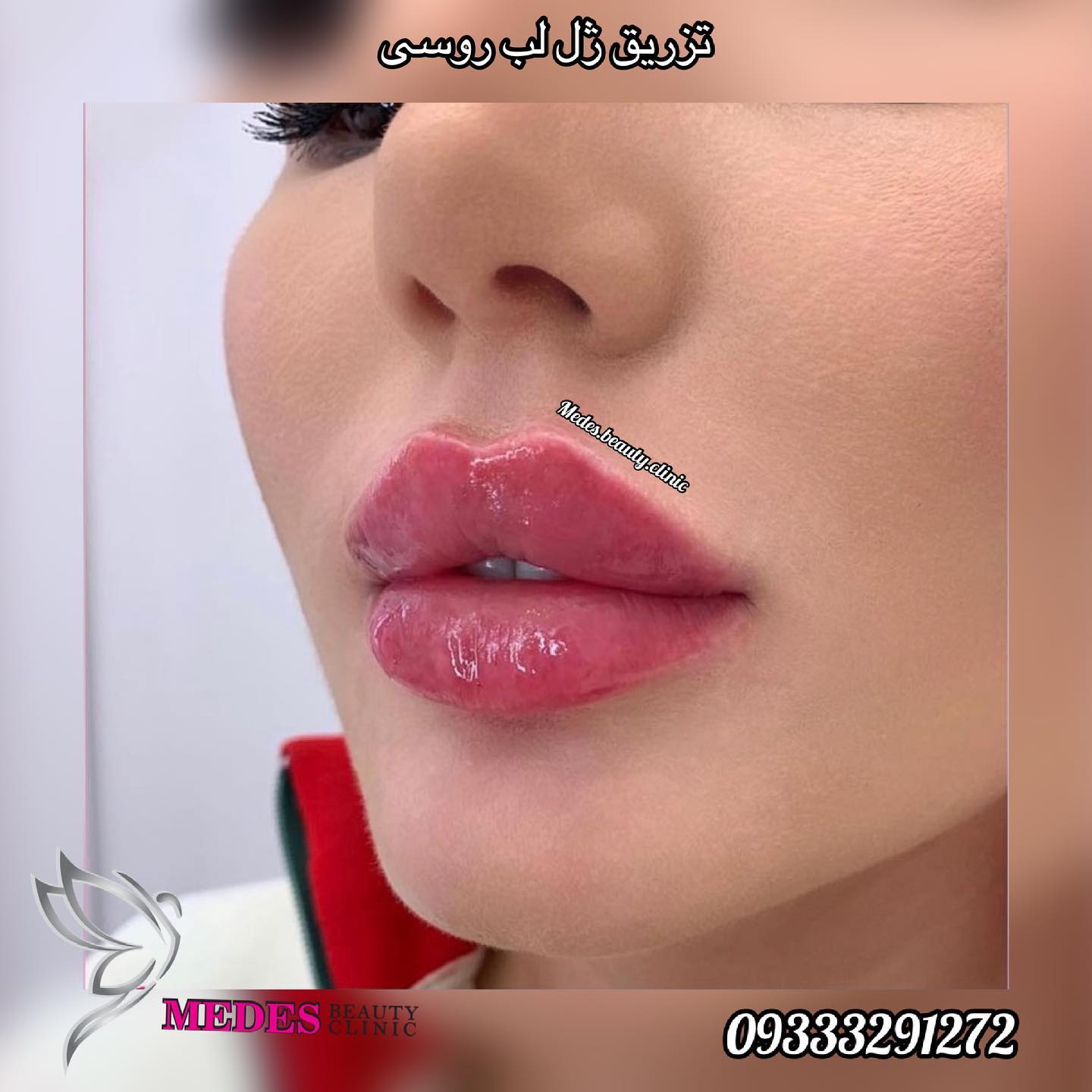 گالری تزریق ژل لب